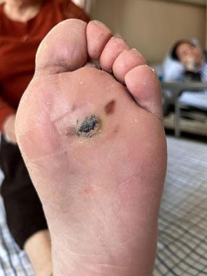 Case report: Malignant melanoma of the lower limb with gastric metastasis